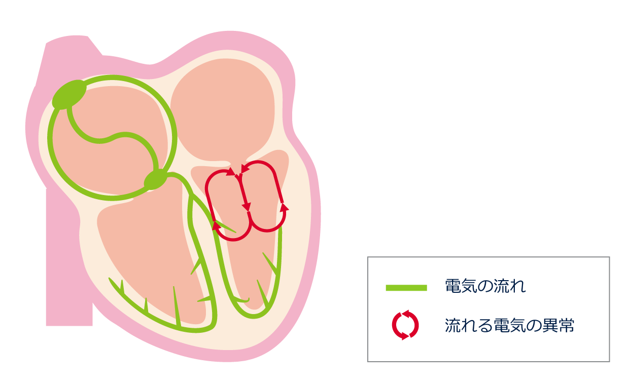 失神 | 頻脈性不整脈